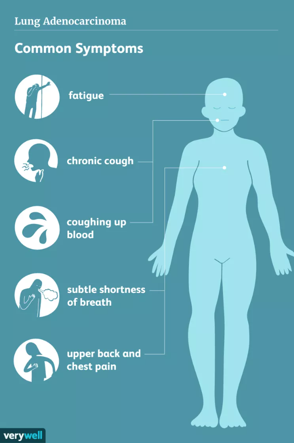 Lung cancer infographic